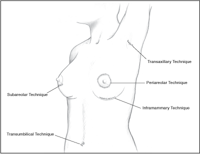 augmentation incisions