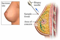 biopsy