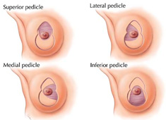 pedicle technique