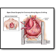 sternotomy